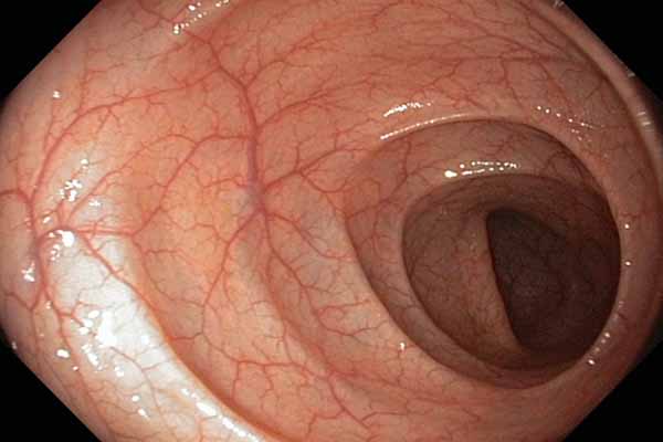 Colonoscopy isn't just for high-risk people